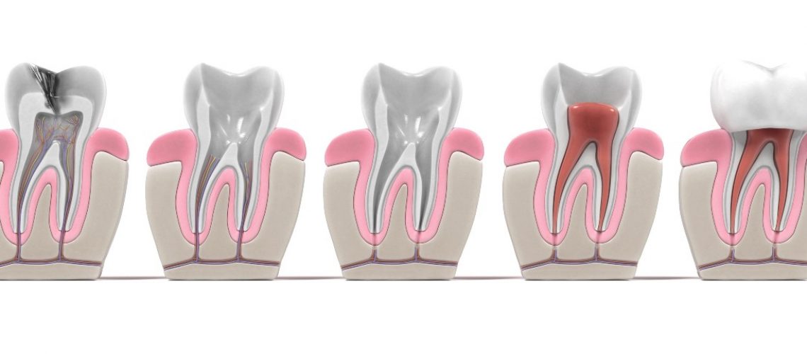 how a root canal works
