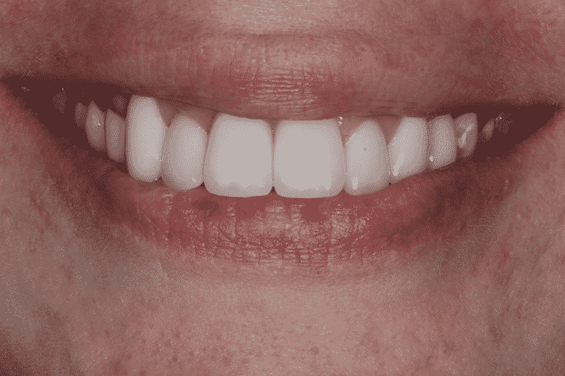 after dental treatment smile