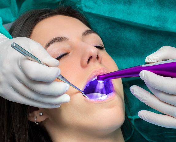 dental sealants being applied to the teeth