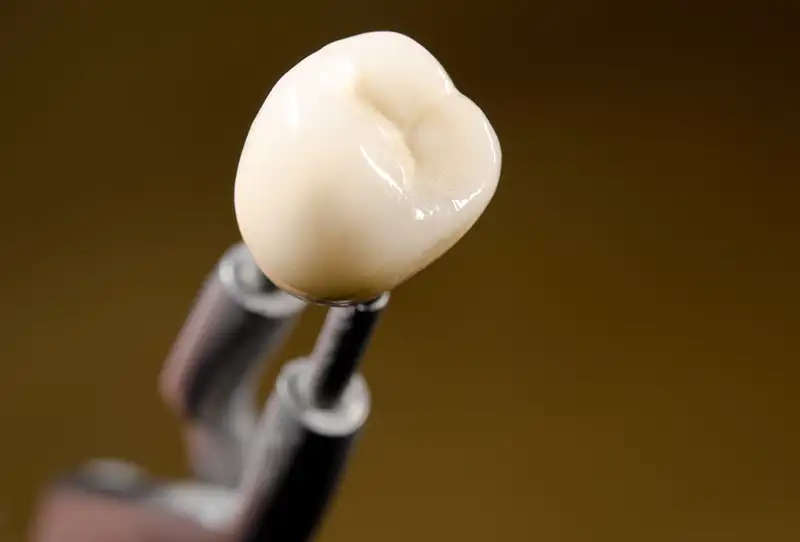 A ceramic dental crown held by tweezers.