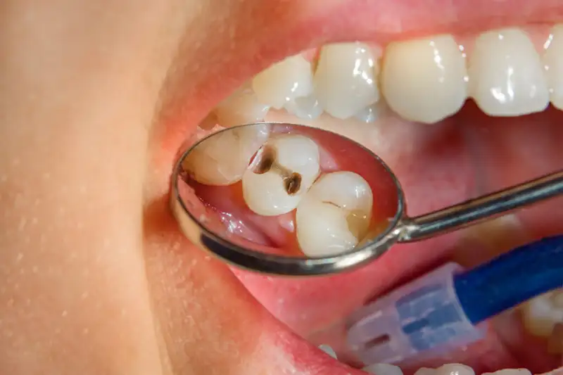 How cavities form concept: a dental mirror is used to inspect a patient's cavity.