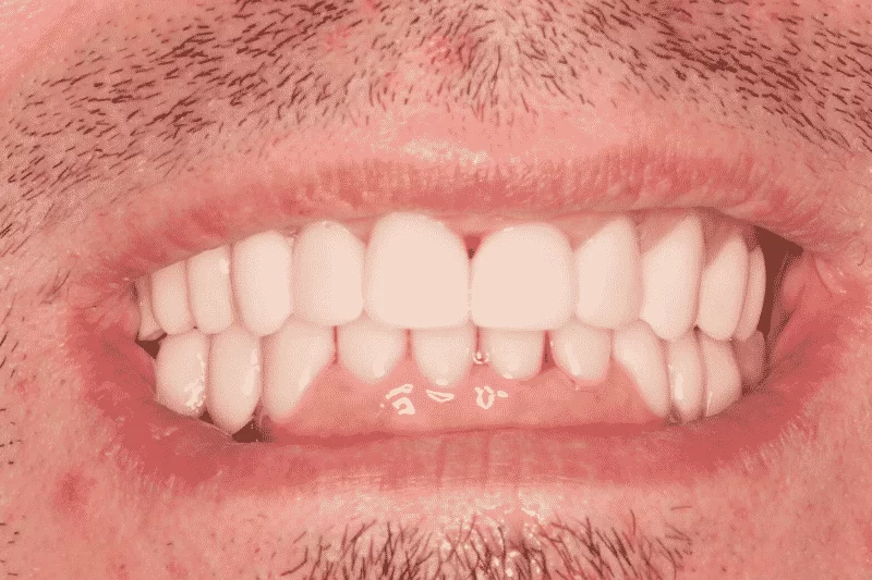 6-2