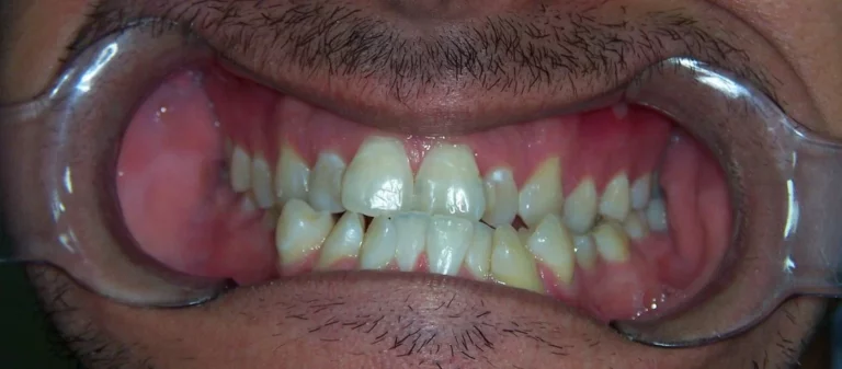 What is the Main Cause of Crooked Teeth?