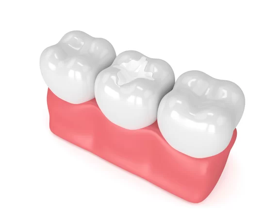 Rendering of dental filling
