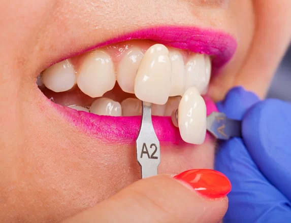 Veneer consultation