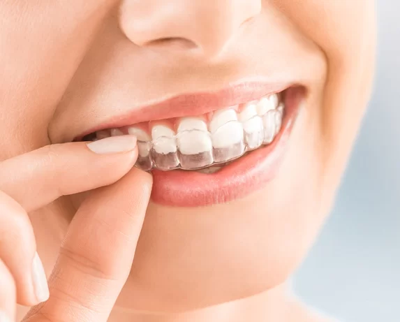 What is Invisalign?