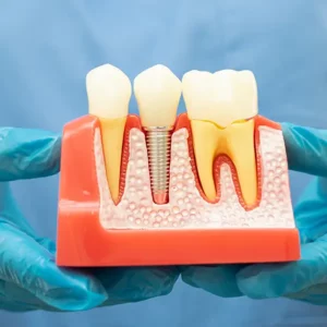 Dental implant prop showing endosteal implant