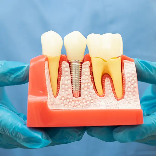 Dental implant prop showing endosteal implant