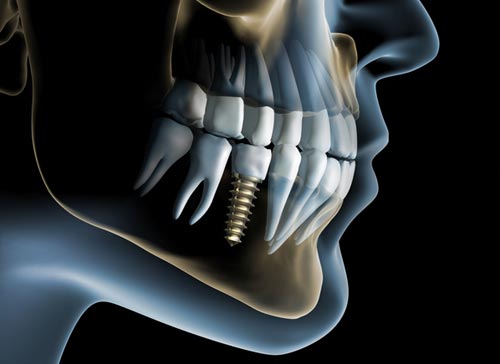 Dental implant in lower jaw
