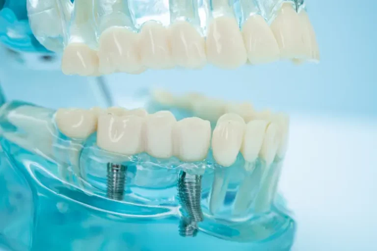 A guide to dental implants: a transparent model jaw shows what implants look like for replacement teeth.