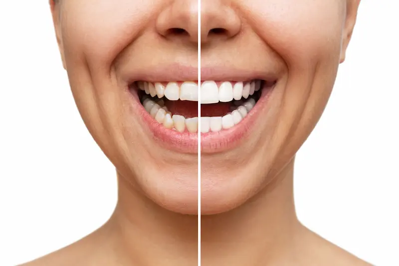 A before-and-after image of porcelain veneers added to the teeth of a dental patient.