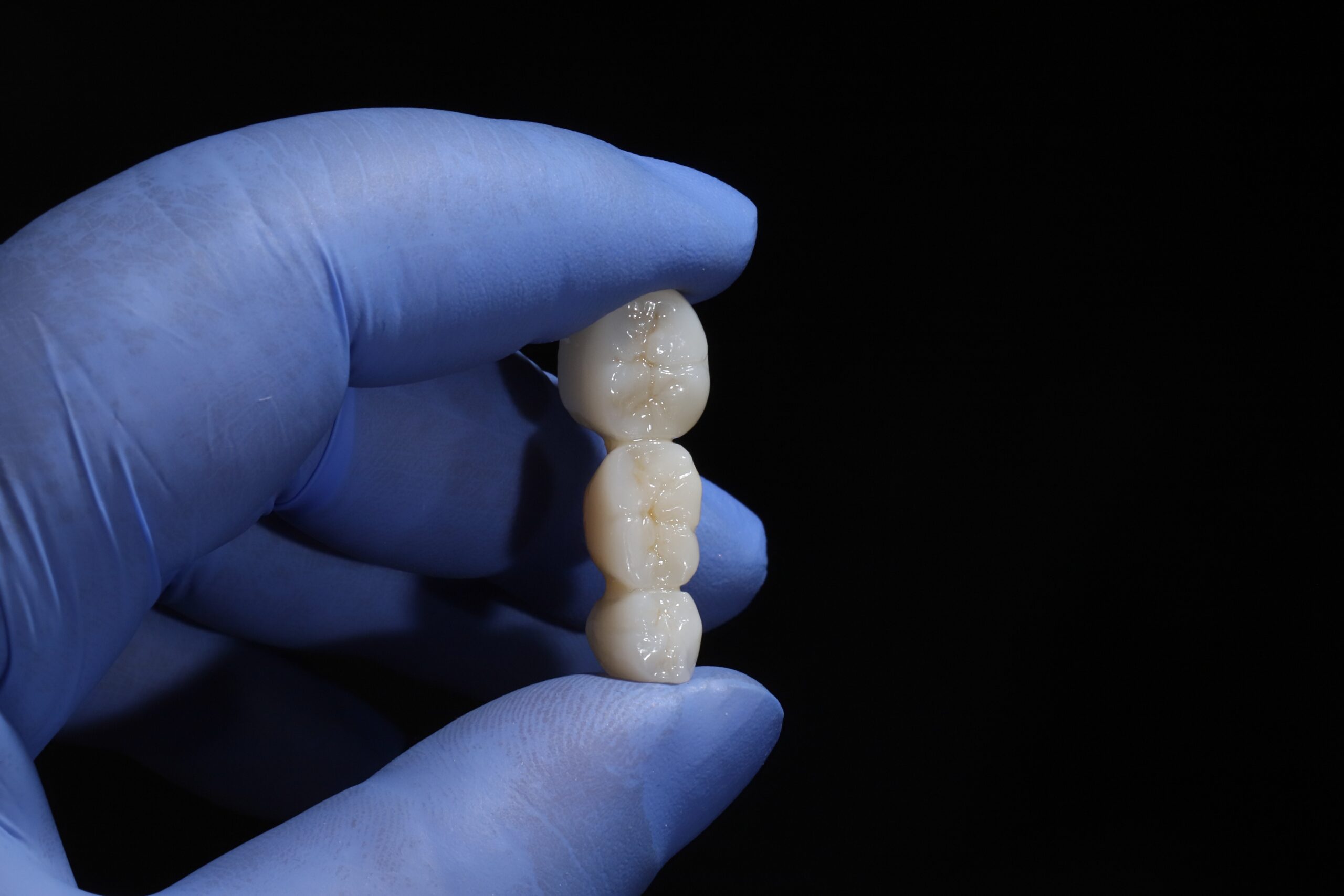 A gloved hand holds three zirconia crowns.