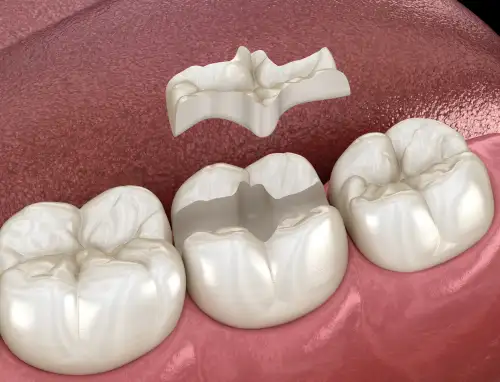 tooth inlay rendering