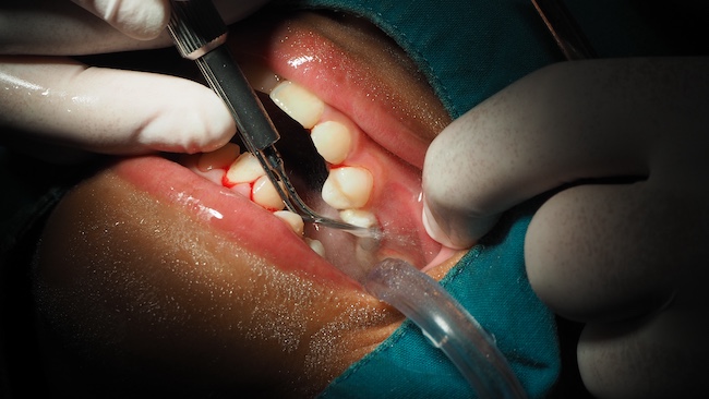 Treating Gum Disease With Periodontal Scaling