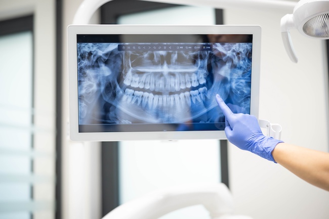 Virginia Beach Dental X-Rays