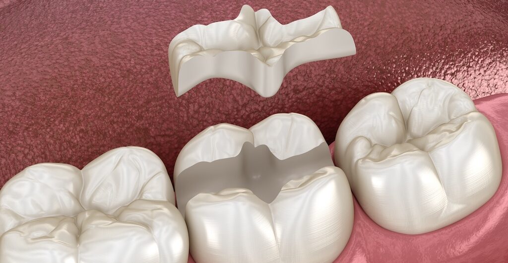 Dental Inlays