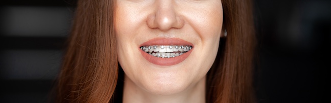Fastbraces® Kecoughtan