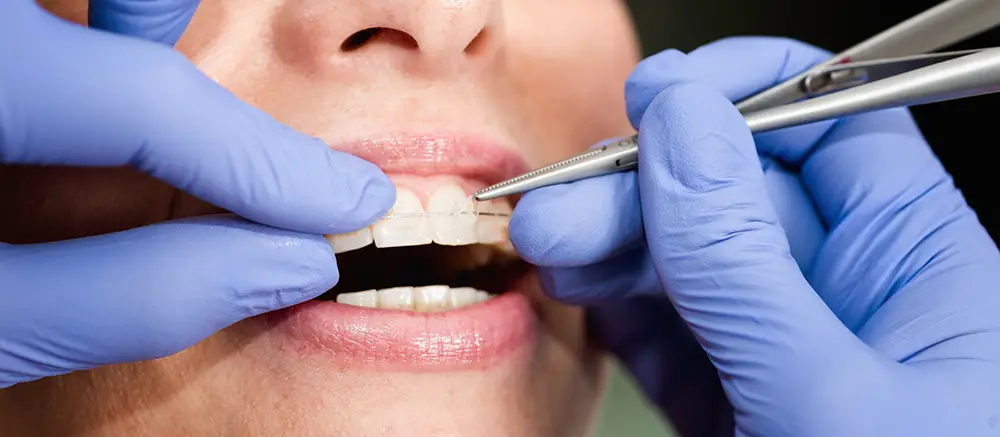 Orthodontists adding Fastbraces