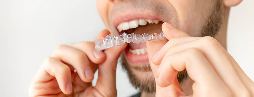 Man putting in his clear aligner