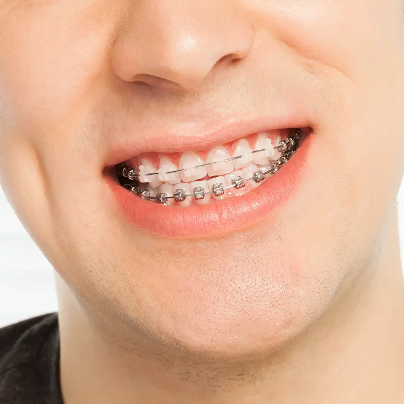 Man with ceramic braces
