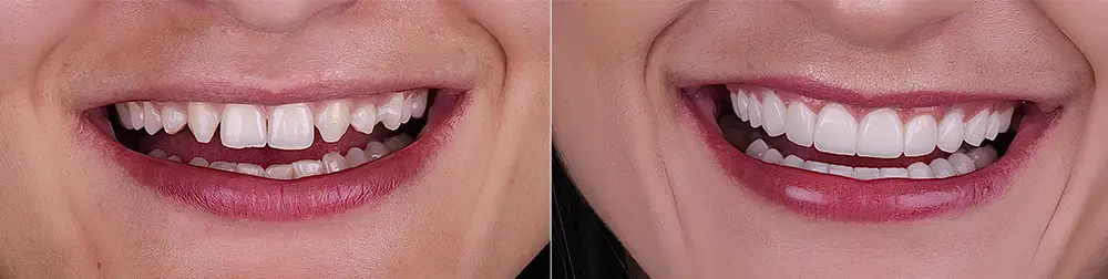 Before and after Veneers