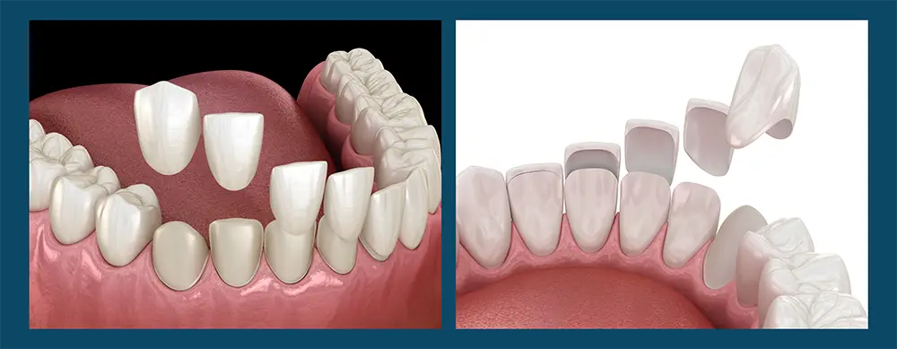 3d examples of veneers