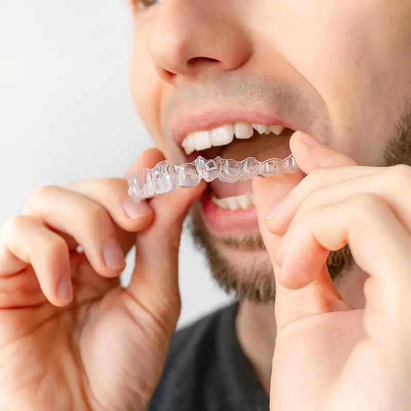 Man putting on clear aligners