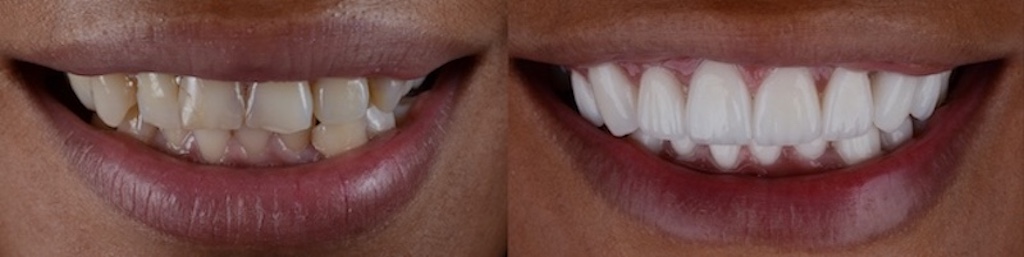 Porcelain Veneers