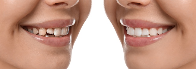 Porcelain Veneers