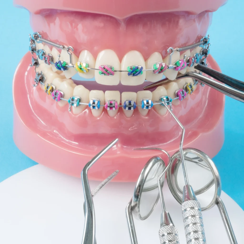 traditional braces on model teeth