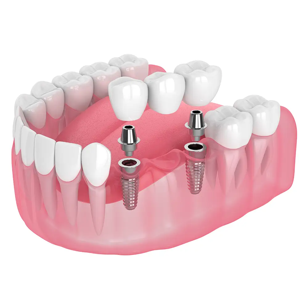 dental implant supported bridges