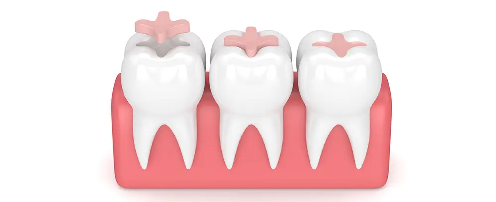 dental inlays