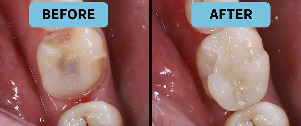 Before and after dental inlay