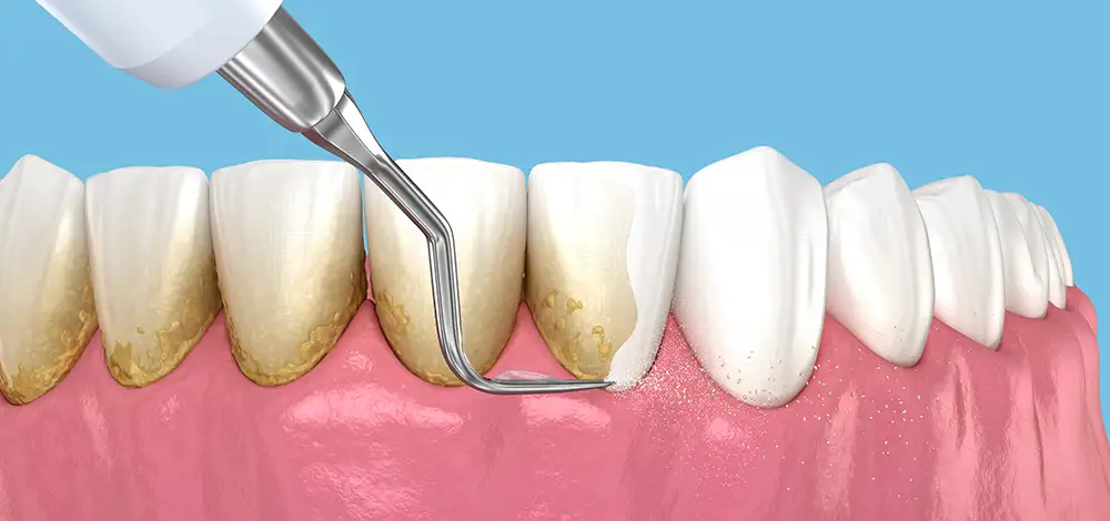 dental cleaning scaling