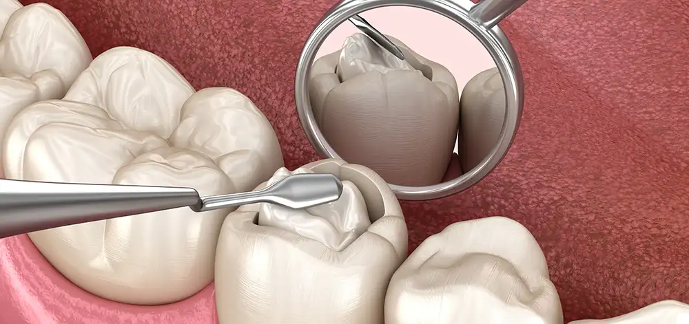 dental fillings 3d render