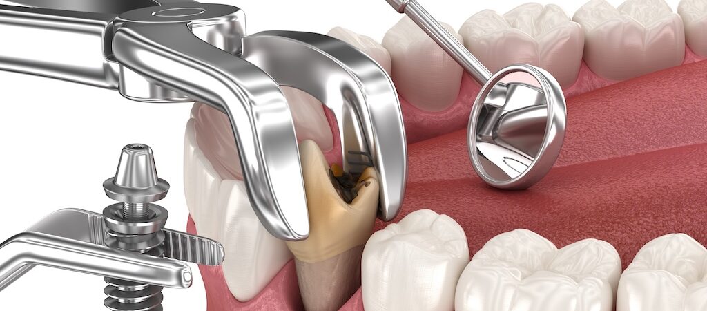 Tooth Extraction