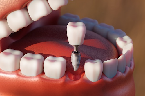 Dental Implant Closeup