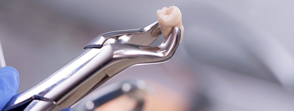 Tooth Extraction