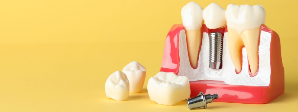 Educational model of gum with a dental implant between teeth on a yellow background.