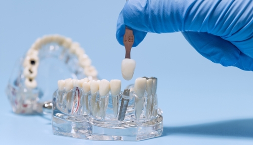 Dental implant procedure in which will cause a dentist to plan out a implant recovery timeline for the patient