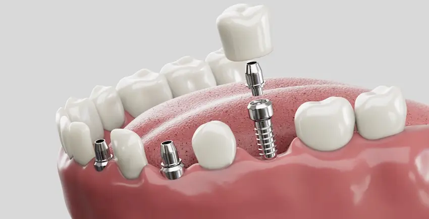 A 3D model of a jaw is showing multiple dental implants with metal posts and white crowns demonstrating the implant restoration process in Virginia.