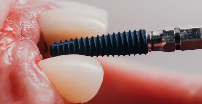 Close-up of the titanium dental implant screw post placed in the jawbone between natural teeth for tooth replacements at The Foleck Center.