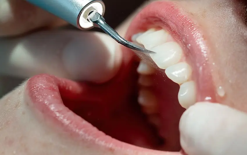 A close-up of a dental scaler tool being used to clean the surface of a patient's upper front teeth during an in-office dental cleaning procedure in Virginia.