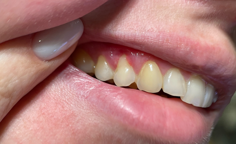 Extreme close-up of teeth with visible plaque buildup along the gumline