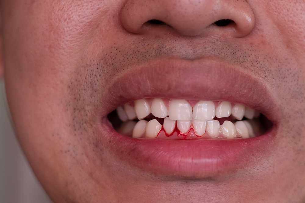 Close-up of a man's teeth showing blood along the gumline