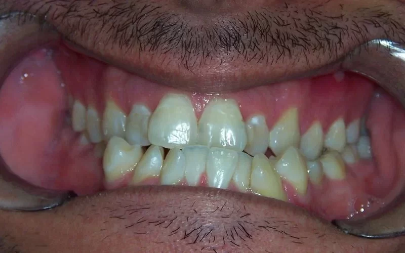 What is the Main Cause of Crooked Teeth?