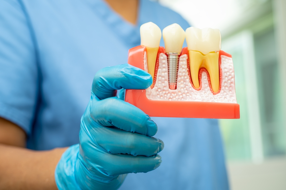Dental implant, artificial tooth roots into jaw, root canal of dental treatment, gum disease, teeth model for dentist studying about dentistry.