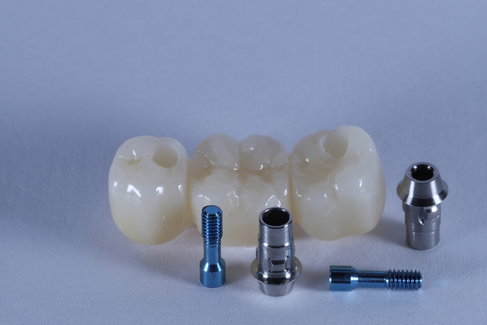 Dental implant treatment. Bridge and crown treatment made of zirconium and E-Max porcelain in dental dentistry. Screw retained implant supported dental prosthesis. smile makeover.
