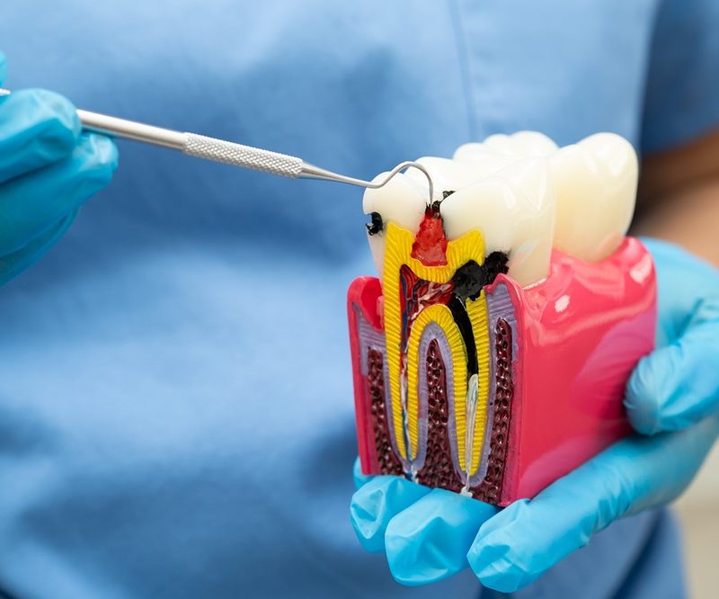Dental provider in blue gloves using an explorer tool to point at a cross-section tooth model showing decay and root canal treatment