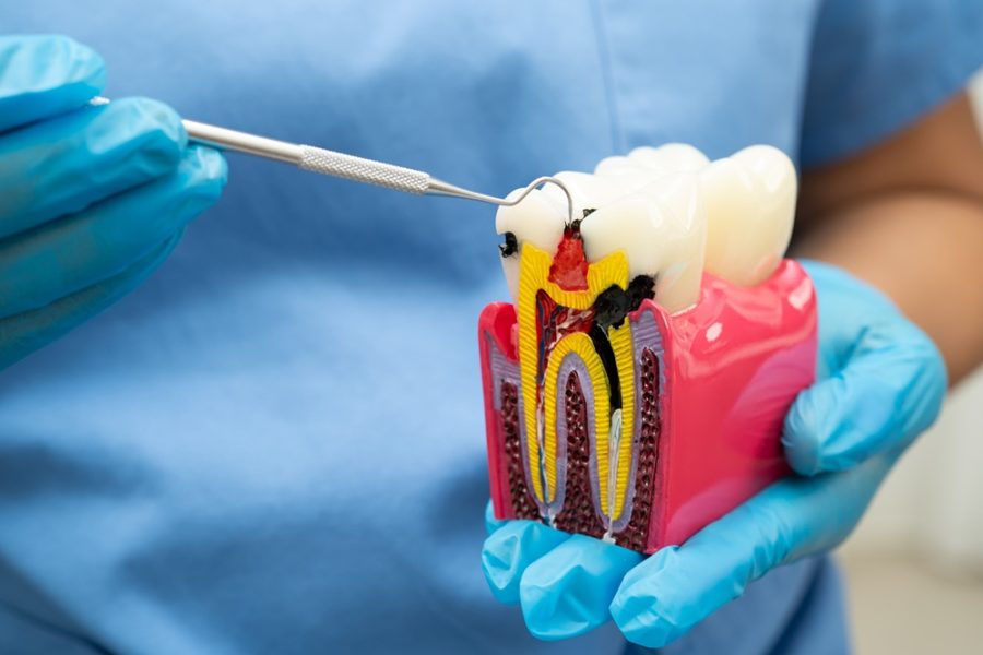 Dental provider in blue gloves using an explorer tool to point at a cross-section tooth model showing decay and root canal treatment